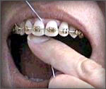 Flossing between your teeth with Orthodontics